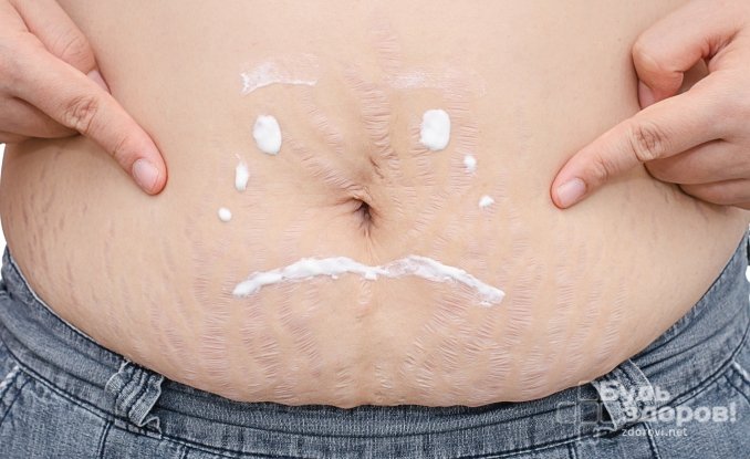 Как убрать растяжки в домашних условиях